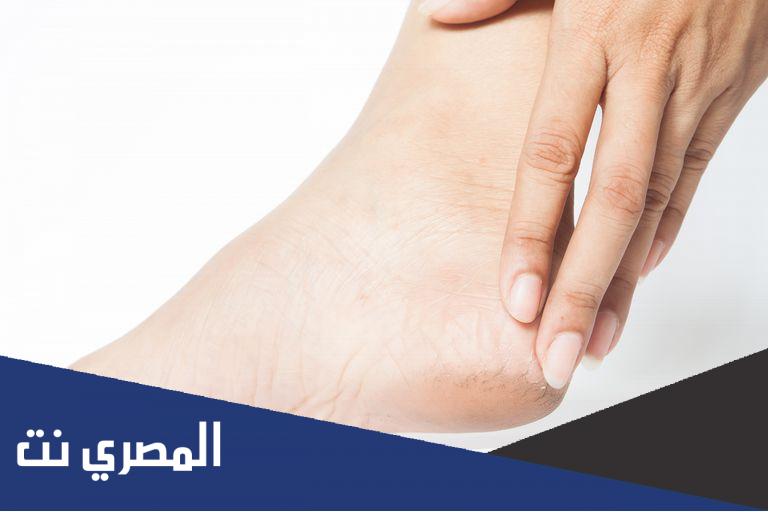 علاج تشقق القدمين وجفافها وآثاره