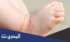 سبراي ترايفاتراسين Trivatracin لعلاج الاكزيما