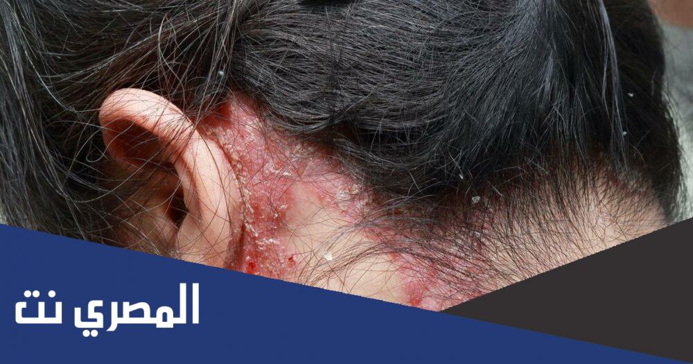 صدفية الشعر وأهم أسبابها وطرق علاجها