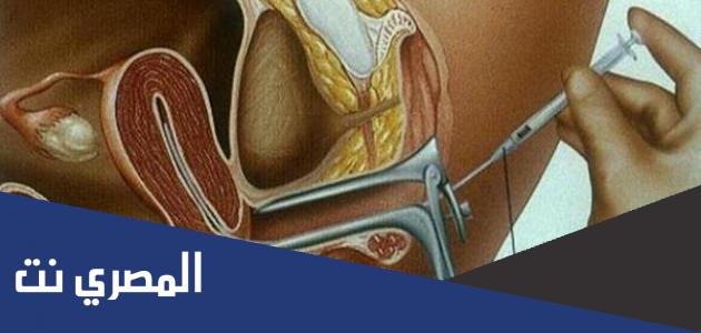 معلومات جديدة عن التلقيح الصناعى