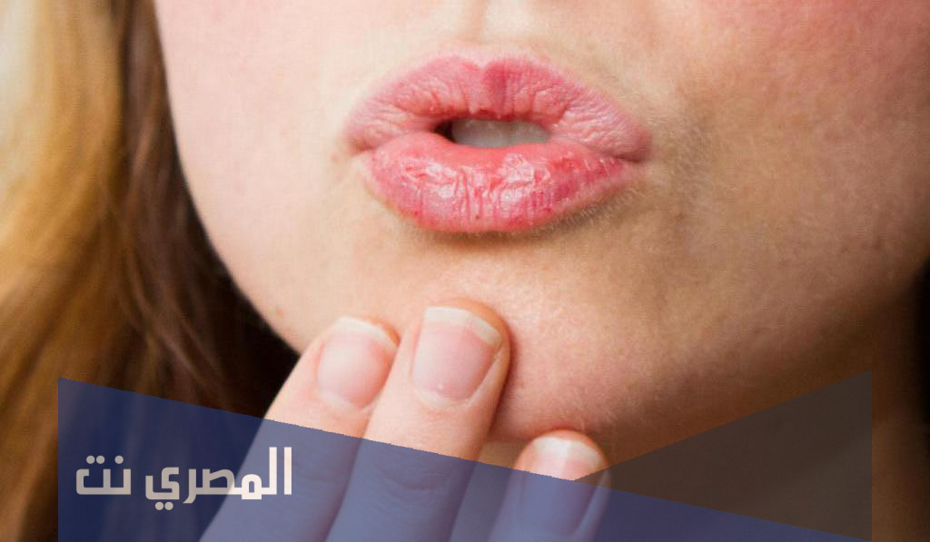 وصفات طبيعية لعلاج تشقق الشفاة