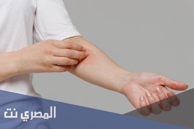 أورازون Orazone لعلاج الحساسية الجلدية