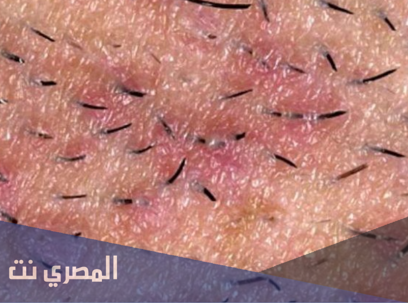 أسباب نمو الشعر تحت الجلد وعلاجه وطرق التخلص منه