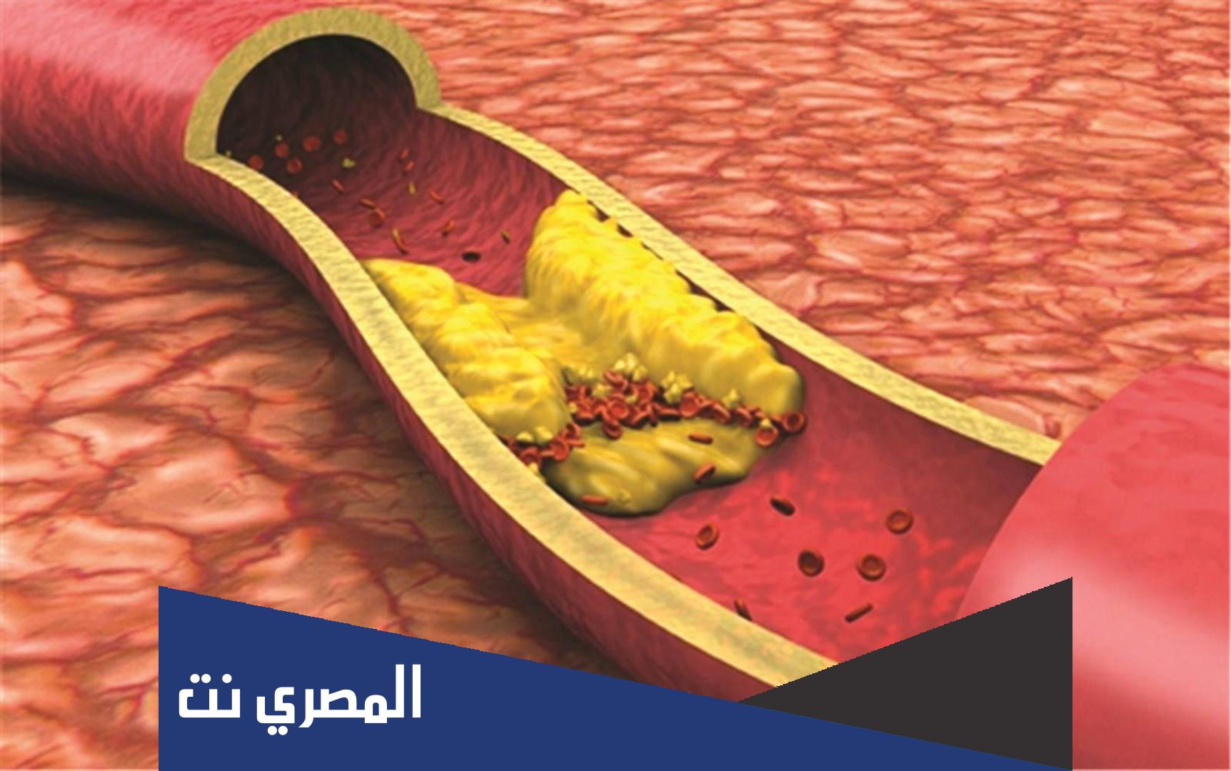أعراض الدهون الزائدة والكوليسترول في الدم