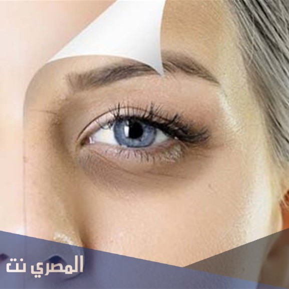 أفضل الطرق لإزالة الهالات السوداء حول العين