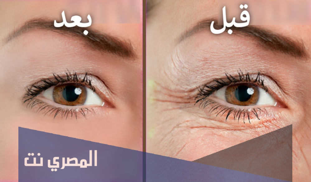 أهم عنصر غذائي للتخلص من التجاعيد والترهل