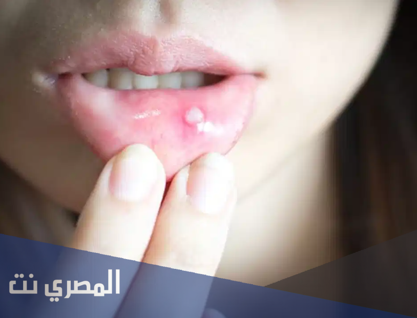 إليك ثمانية أسباب لظهور قرح الفم