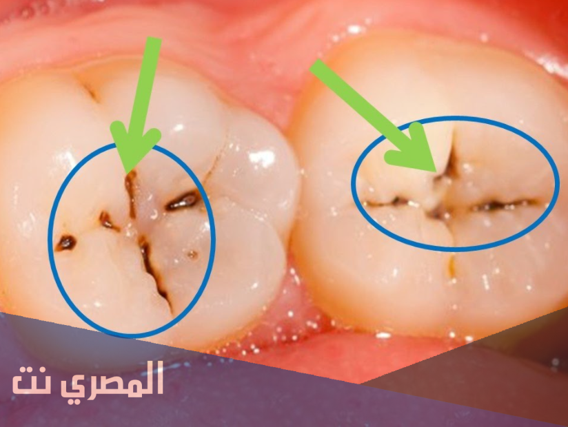 الحل لتسوس الأسنان والوقاية منه