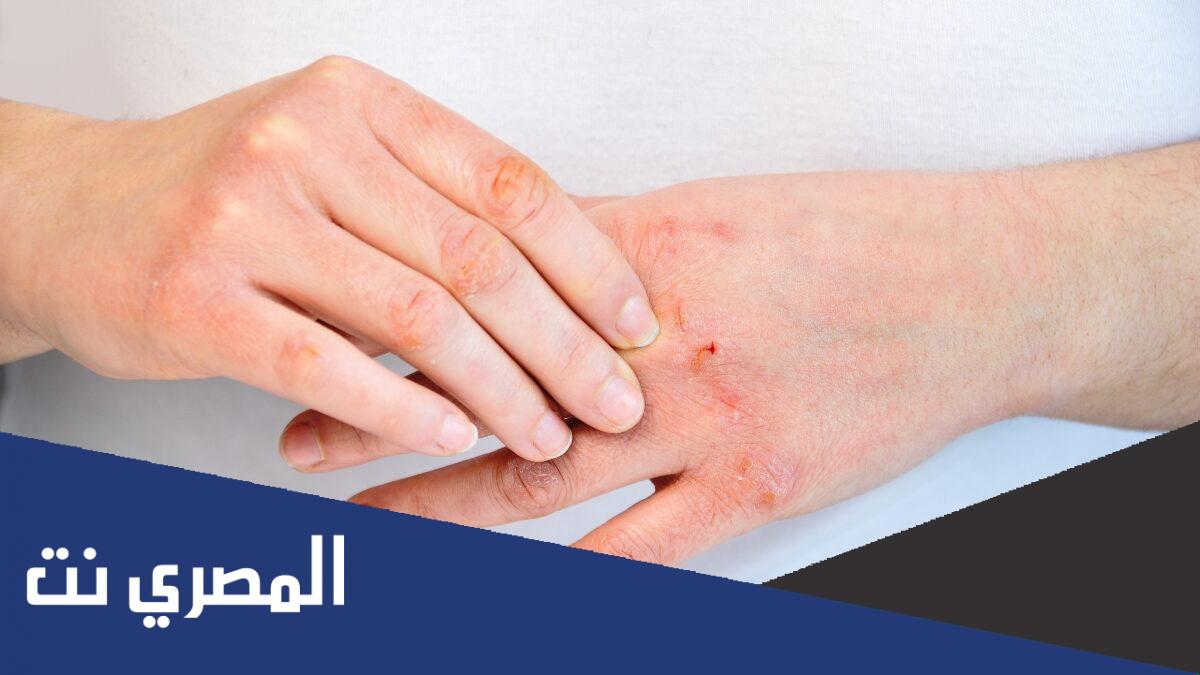 بولى بيوسيد مضاد موضعى للجراثيم POLY BIOCID