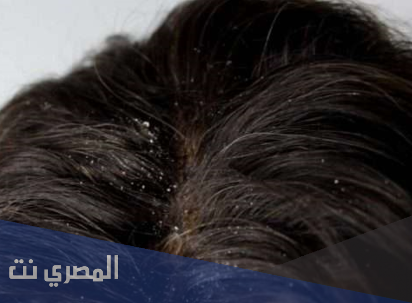 تخلصي من قشرة الشعر بهذه النصائح فقط وتطبيقها