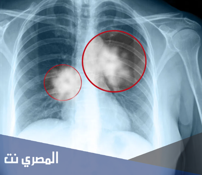 ثمانية أعراض غير متوقعة لسرطان الرئة
