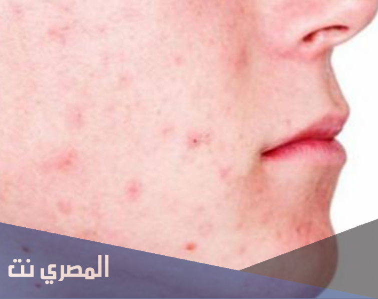 طرق طبيعيّة وسريعة لإزالة حب الشباب