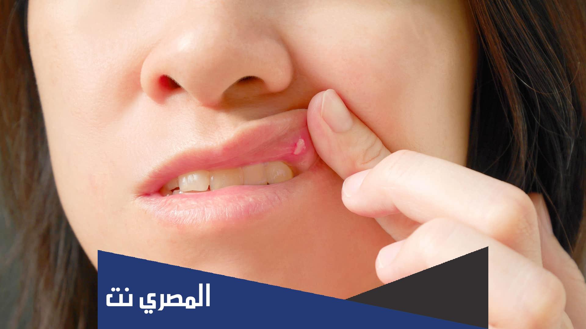 علاج قرحة الفم بأحدث الطرق العلاجية