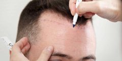 قائمة أسعار زراعة الشعر الطبيعي في الجزائر