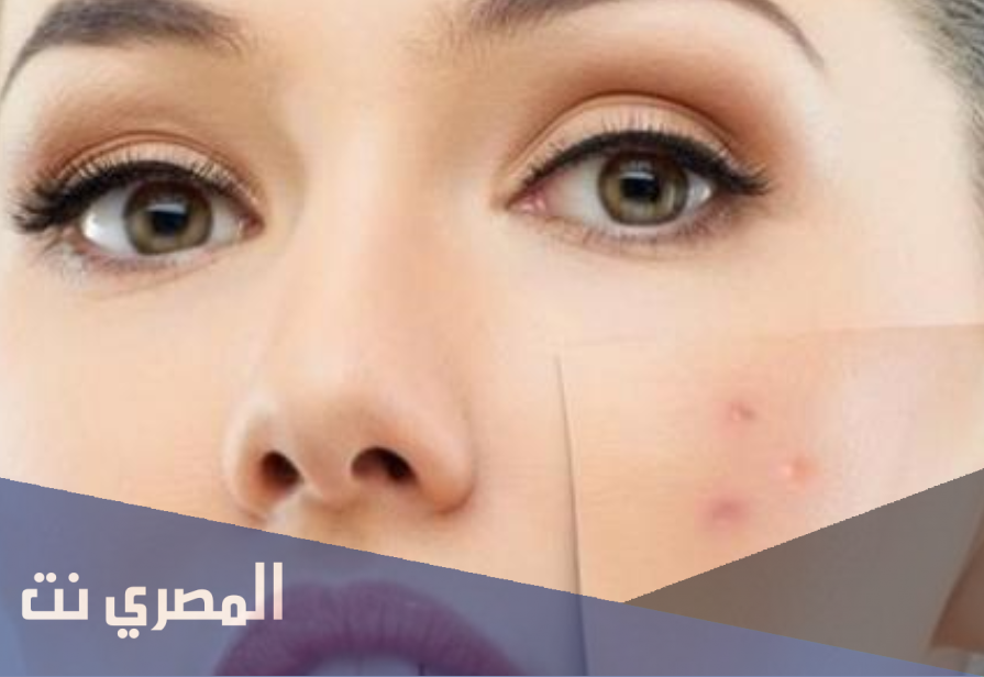 كيفية ازالة البثور من الوجه بسرعة علاجات طبيعية للبثور على الوجه