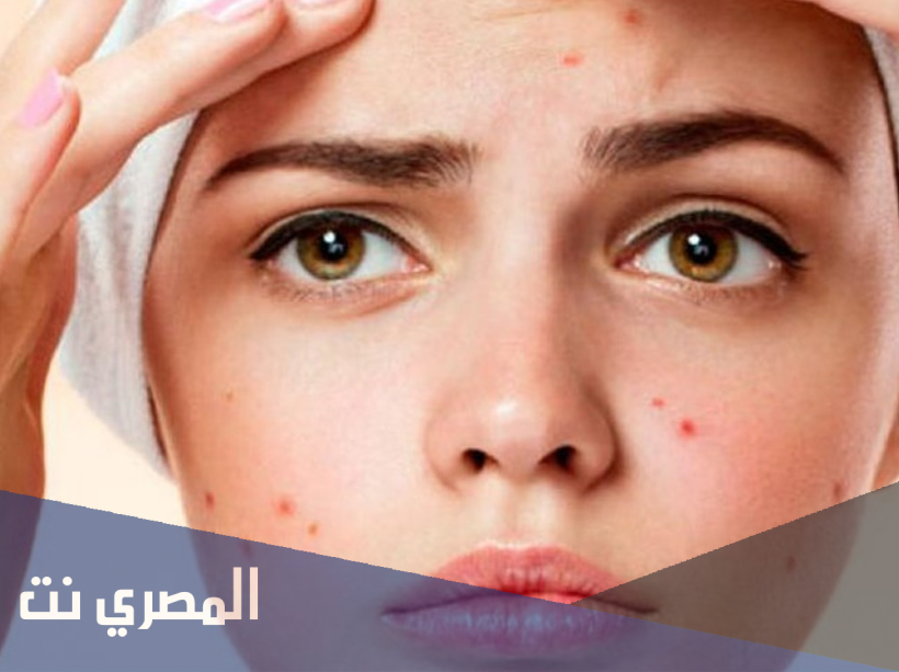 ما هي الأسباب المباشرة للإصابة بحب الشباب