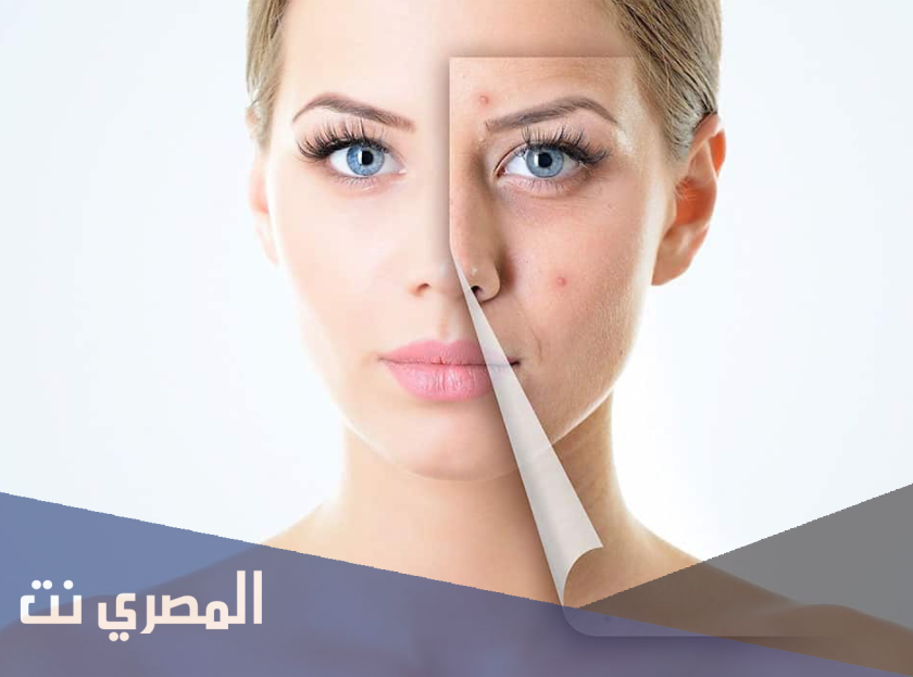 وصفات طبيعية لعلاج حب الشباب