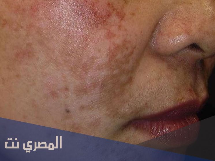 وصفات منزلية طبيعية لعلاج التصبغات الجلدية