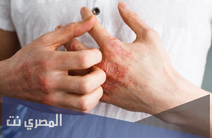 إليكاسال Elicasal مرهم لعلاج الإكزيما وفعاليته