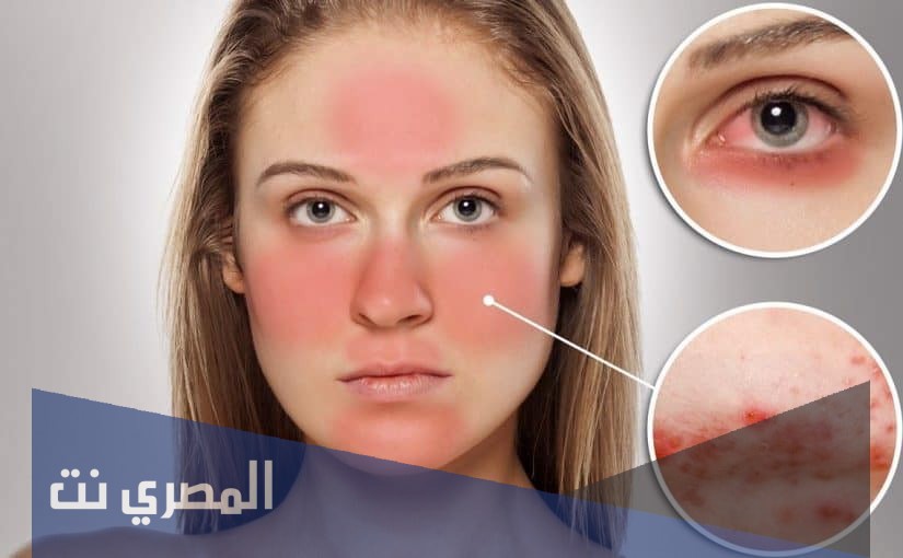 إبيريزين Epirizine Tablets لعلاج للحساسية والالتهابات