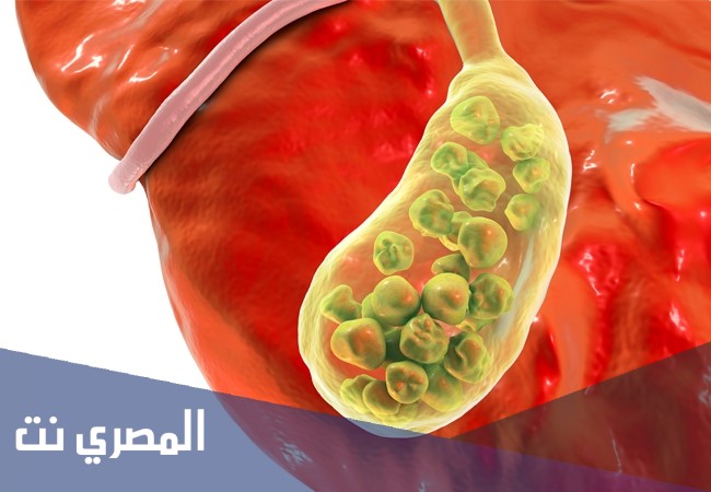 أورسو بلس Urso Plus لعلاج حصوات المرارة وتأثيره