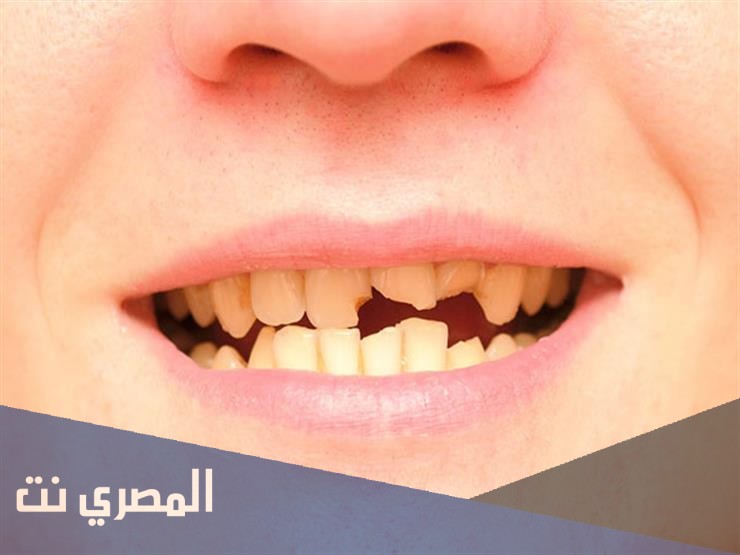 تفسير رؤية تكسر الاسنان والضرس في المنام