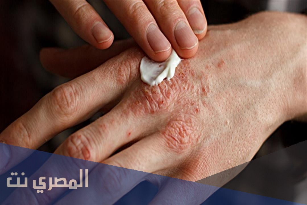 فيوسيكورت Fucicort كريم لعلاج التهاب الجلد وتأثيره
