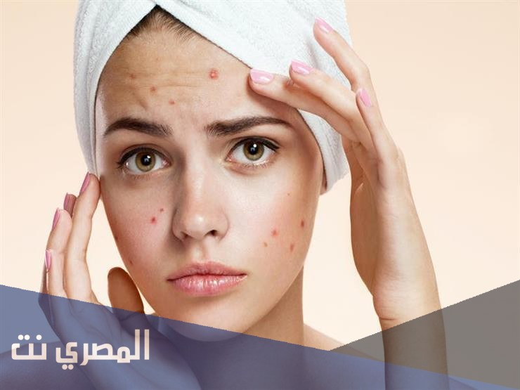 بنزاميسين لعلاج حب الشباب