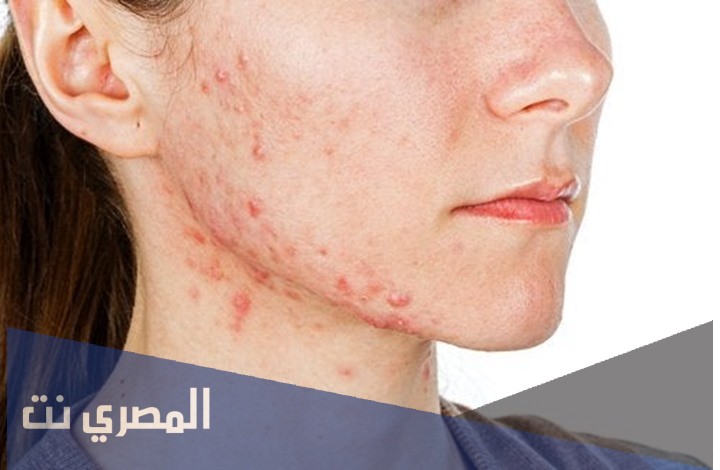 كريم أكرتين Acretin لعلاج حب الشباب وتأثيره