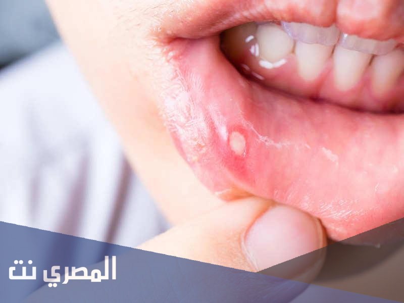 دهان بيرافيكس لعلاج تقرحات الفم واللثة وفعاليته