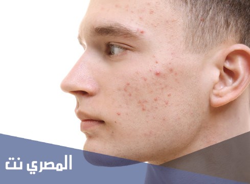 جيل بانوكسيل Panoxyl لعلاج حب الشباب ونتائجه