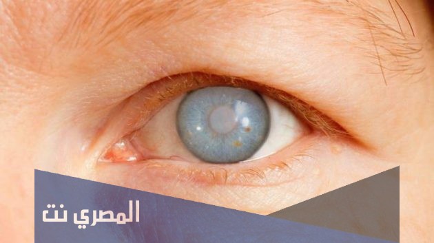 بيتاجان لعلاج جلوكوما العين