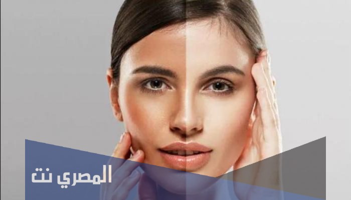 ميلاكير Melecare لعلاج الكلف وتفتيح البشرة ونتائجها