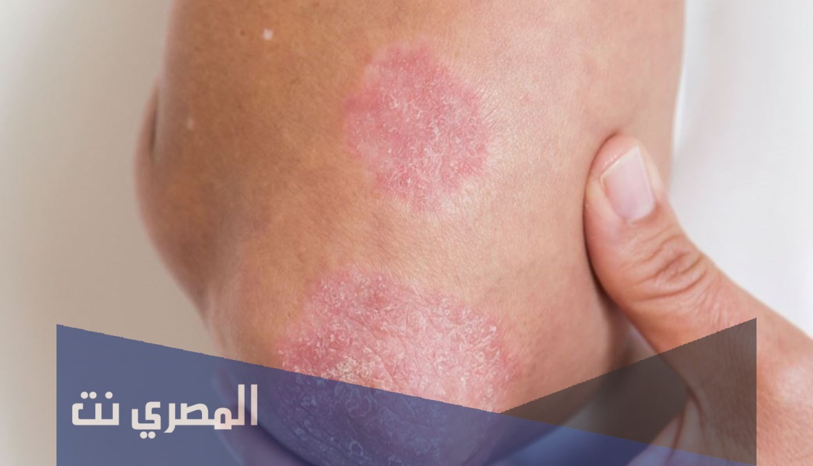 كريم Betapanthen لعلاج الأمراض الجلدية وتأثيره