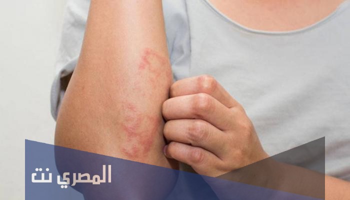 بروتوبيك كريم لعلاج التهابات الجلد