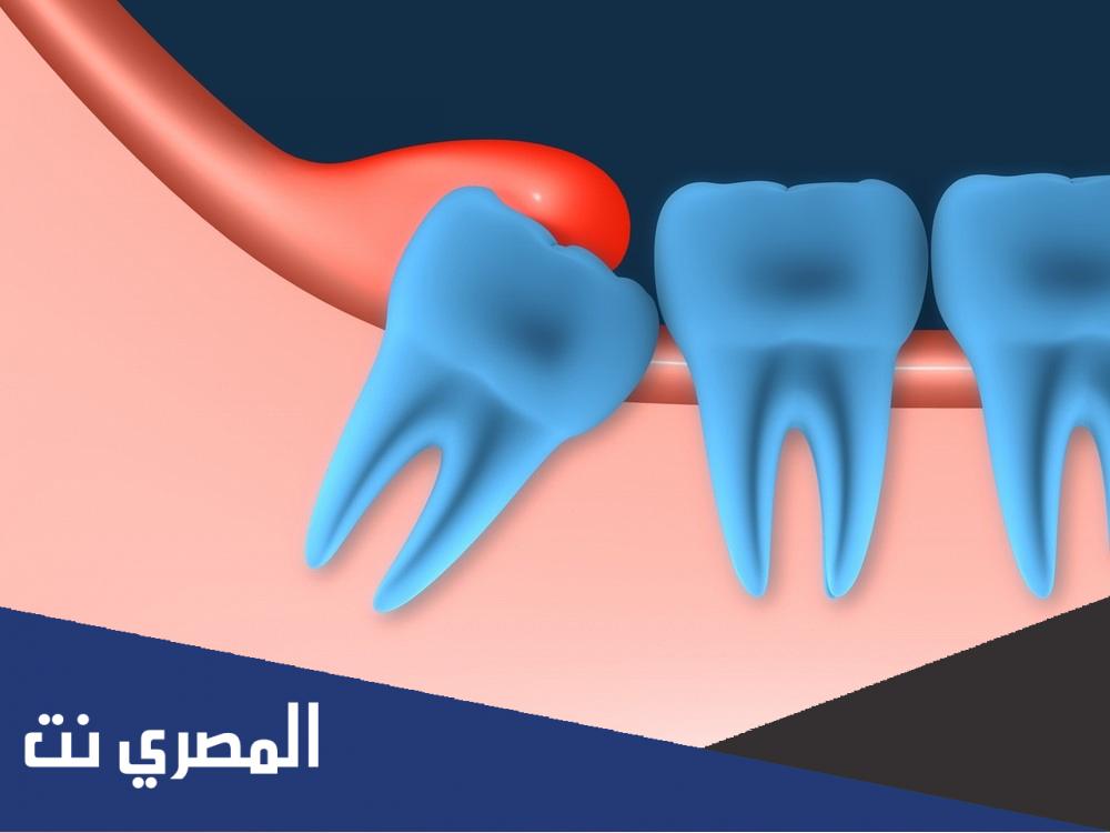 فوائد ازالة ضرس العقل