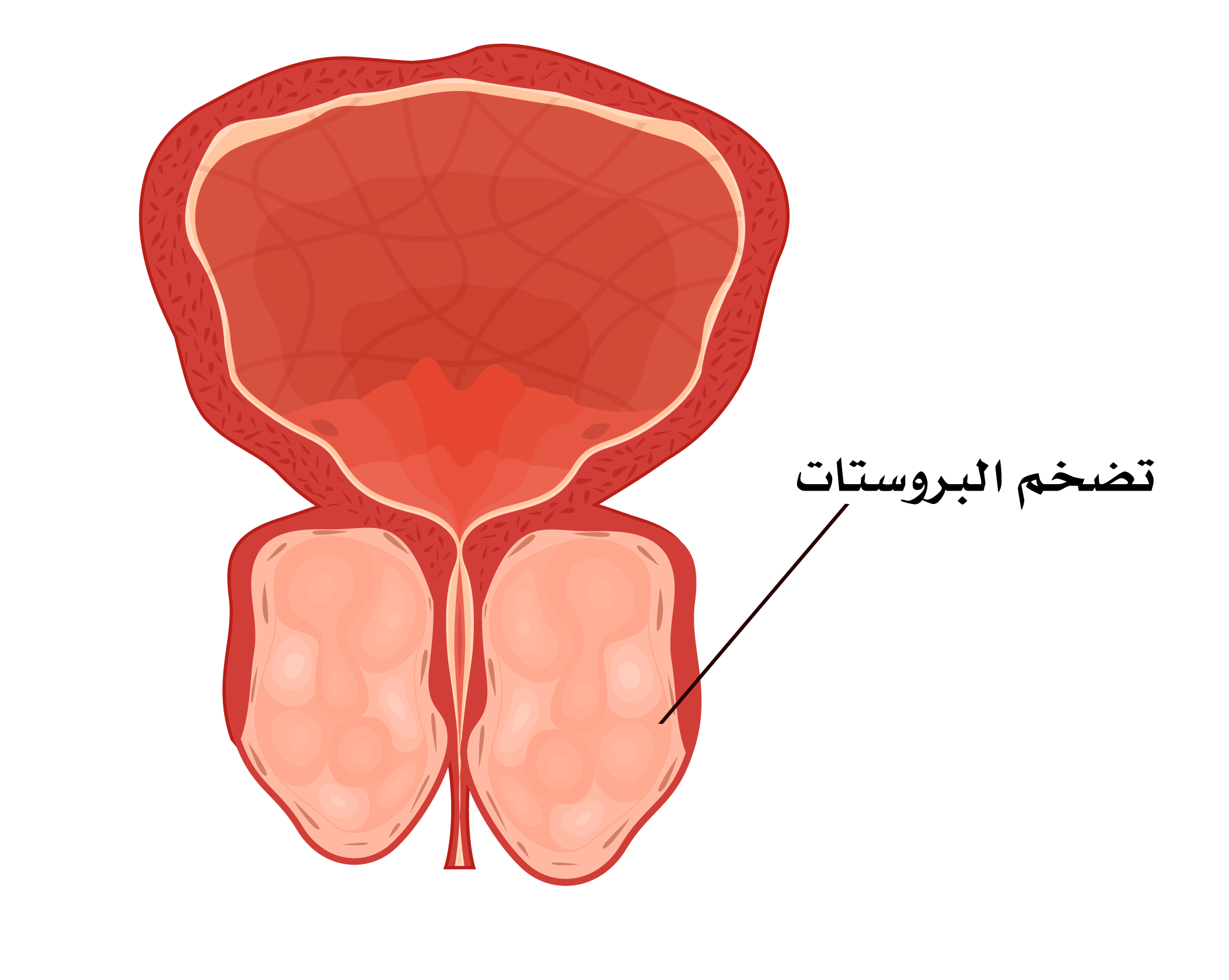 أقراص بروستيترول لعلاج تضخم البروستاتا الحميد وتأثيره