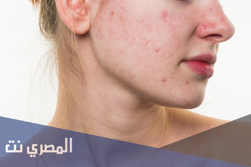 طريقة استعمال ايفاكلار لعلاج حب الشباب ونتائجه
