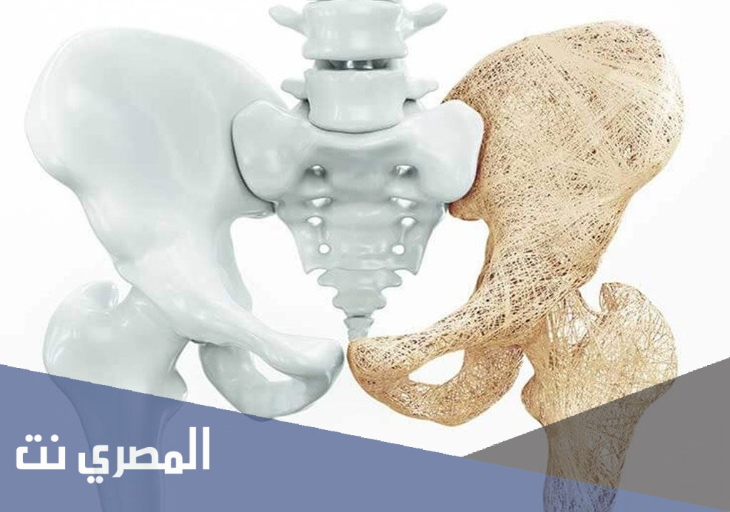 أقراص بروكال لعلاج هشاشة العظام وفعاليته