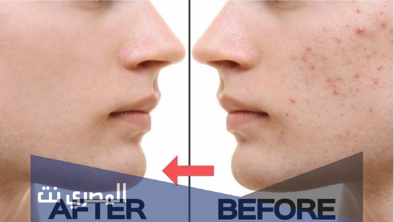 Acne Stop لعلاج حب الشباب