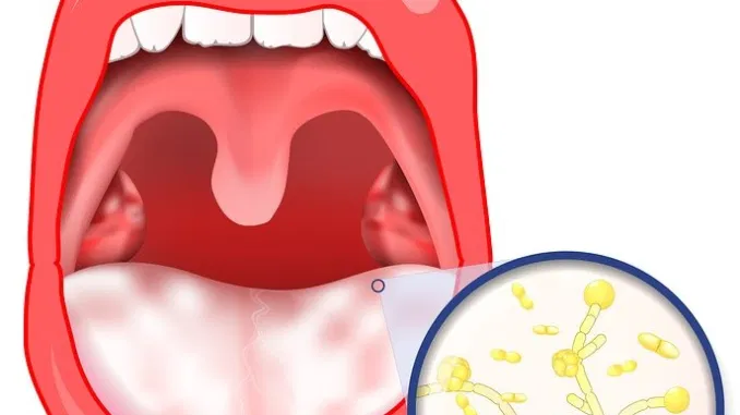 ميكوستات Mikostat لعلاج الفطريات ونتائجه