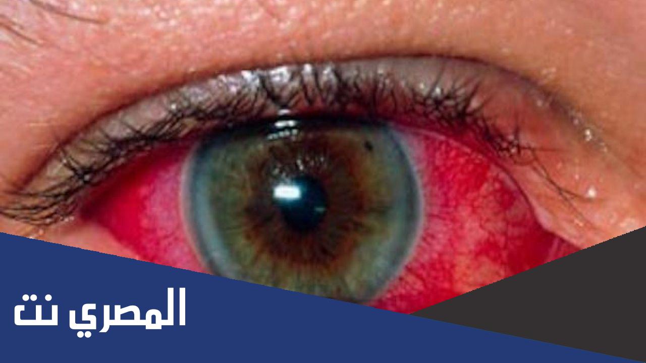 أسباب إنتشار مرض الرمد