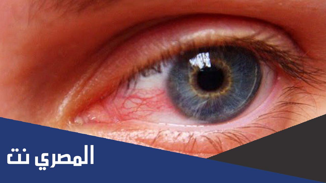 أسباب احمرار العين وكيفية علاجها