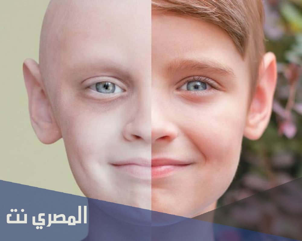 أسباب اللوكيميا عند الأطفال