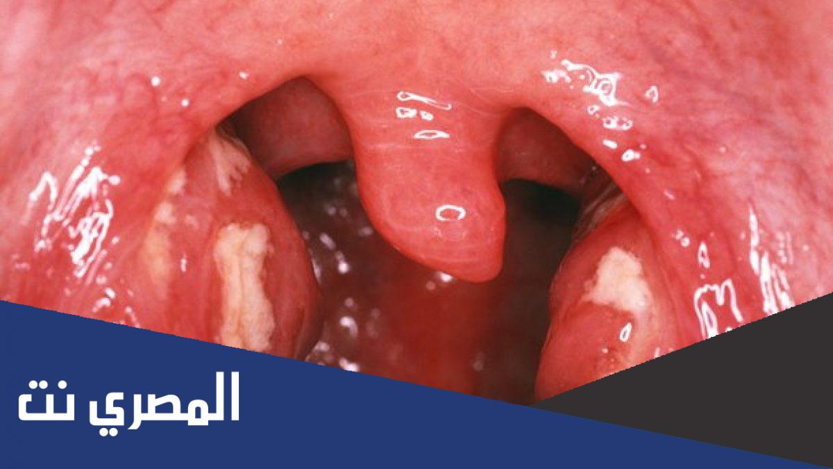 أسباب حدوث صديد اللوز