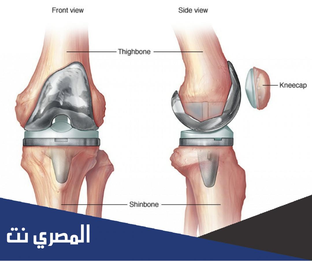 أضرار عملية تغيير مفصل الركبة بالتفصيل