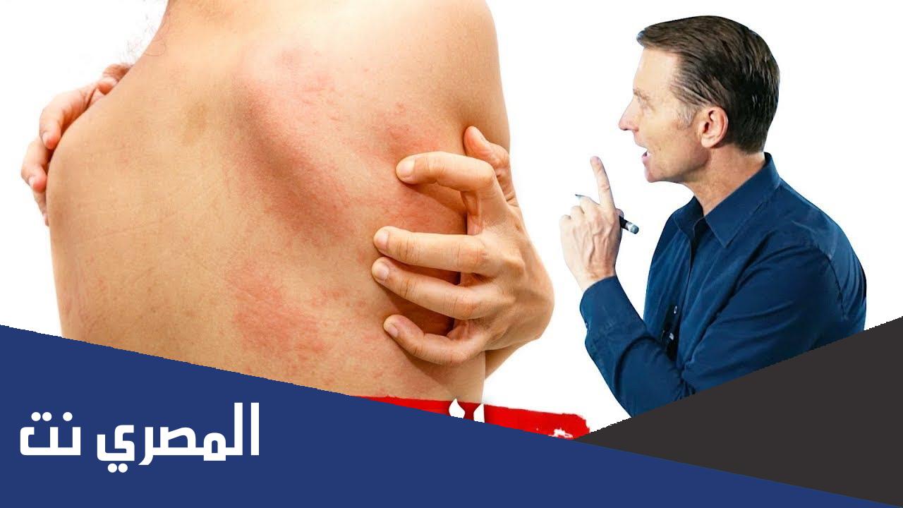 أعراض حساسية السمك