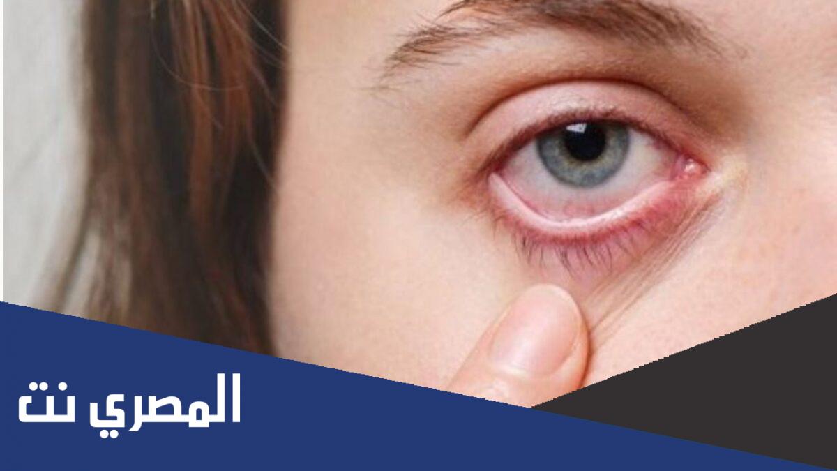 أعراض حساسية العين وعلاجها
