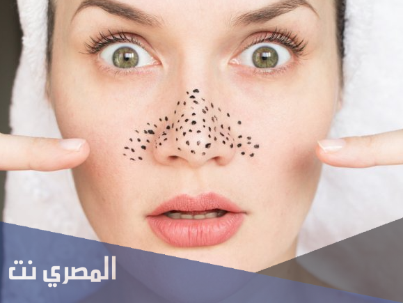 أفضل طرق لإزالة الرؤوس السوداء من الانف