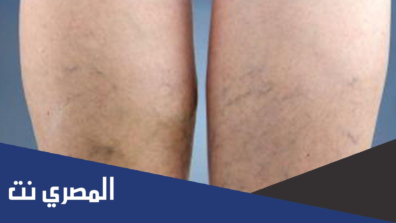 أفضل وصفة لعلاج الدوالي